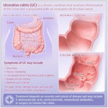 ¿Qué es la colitis ulcerosa?