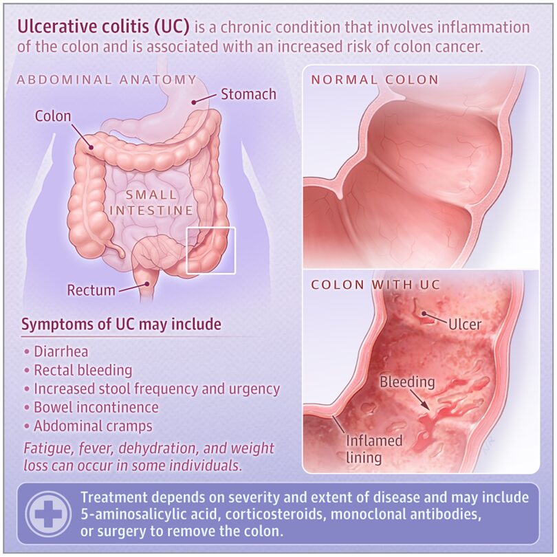 ¿Qué es la colitis ulcerosa? Síntomas, diagnóstico, tratamiento y seguimiento.
